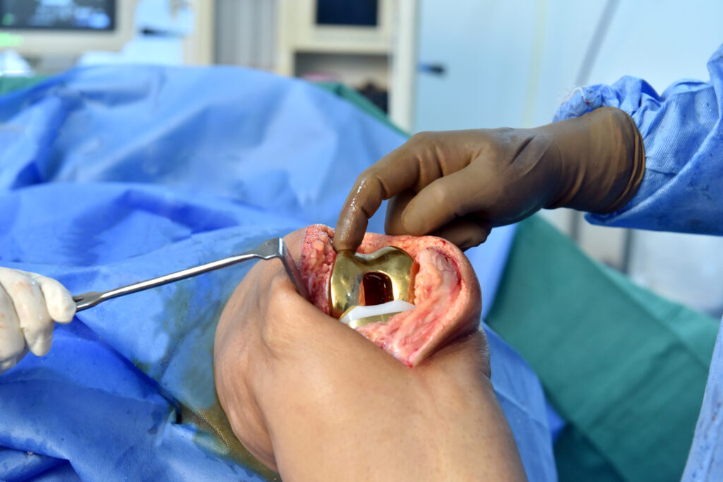 Total Knee Replacement Surgery with Gold Implant